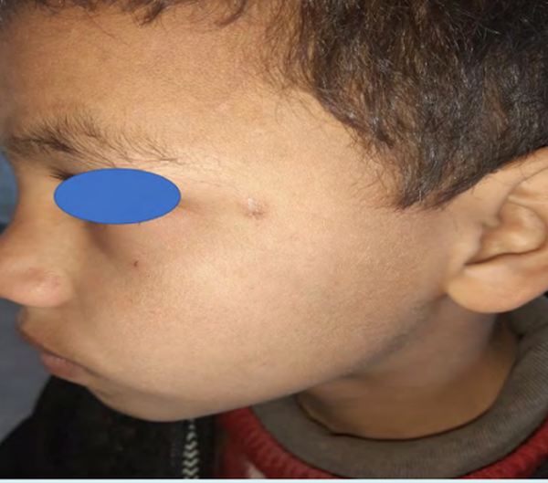 YÜZDE AĞRISIZ LEZYON olgusu - Tıp Fakültesi Öğrencisi  4. Sınıf kategorisi