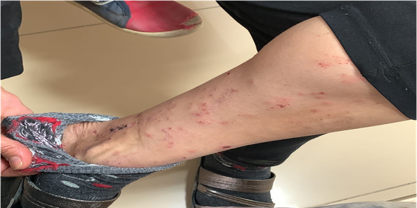 BACAKLARDA KAŞINTILI LEZYONLAR olgusu - Tıp Fakültesi Öğrencisi  4. Sınıf kategorisi