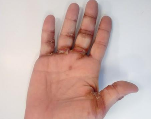 EROZYONLU, PULLANMALI LEZYONLAR olgusu - Tıp Fakültesi Öğrencisi  4. Sınıf kategorisi