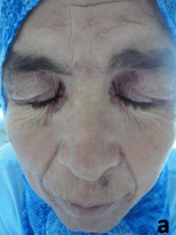 KAŞINTILI HİPERPİGMENTE YAMALAR olgusu - Tıp Fakültesi Öğrencisi  4. Sınıf kategorisi