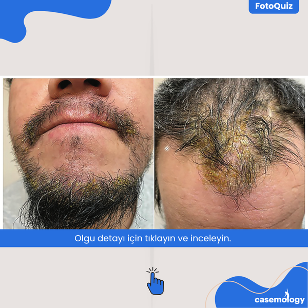 TEKRARLAYAN ERİTEMLİ PLAKLAR olgusu - Tıp Fakültesi Öğrencisi  4. Sınıf kategorisi
