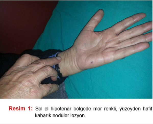 VÜCUTTA NODÜLER LEZYONLAR olgusu - Tıp Fakültesi Öğrencisi  4. Sınıf kategorisi