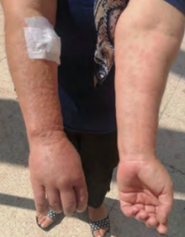 KOLLARDA KAŞINTILI DÖKÜNTÜLER olgusu - Tıp Fakültesi Öğrencisi  4. Sınıf kategorisi
